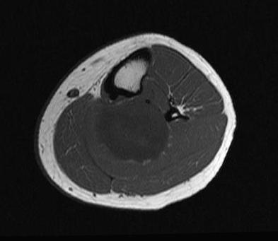 Neurofibrosarcoma Axial MRI Neurofibromatosis